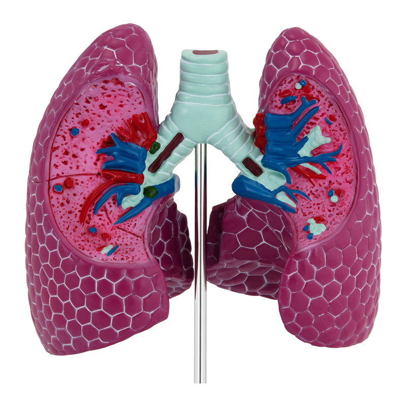 Plaučių modelis su patologijomis PHY-LM-1