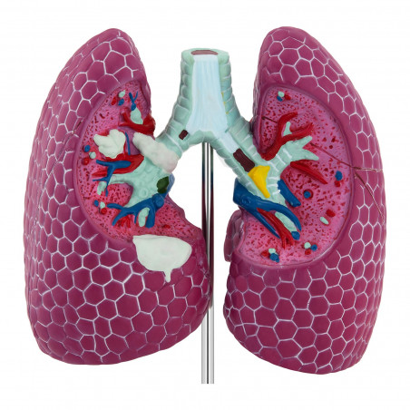 Plaučių modelis su patologijomis PHY-LM-1